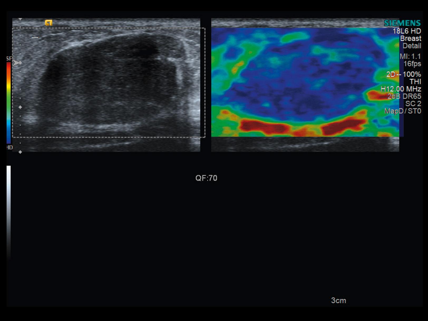 eSie Touch Imaging of breast fibroadenoma