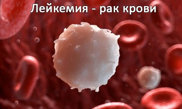 Лейкемия - рак крови. ОФТН-03-«Аксион»